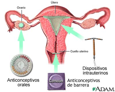 Métodos de control de natalidad