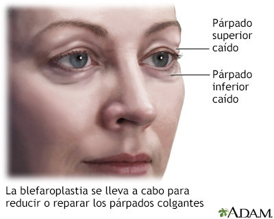 Blefaroplastia - serie