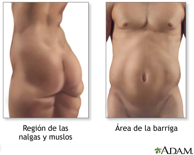 Liposucción - Serie - Indicaciones