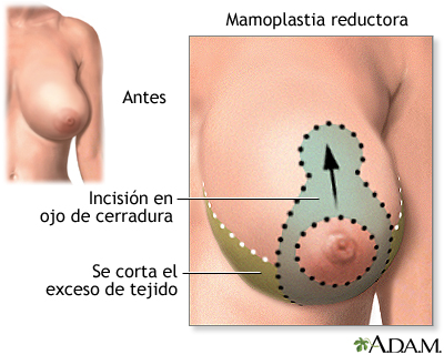 Incisión