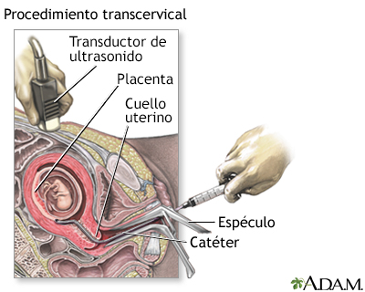 Procedimiento (segunda parte, transcervical)