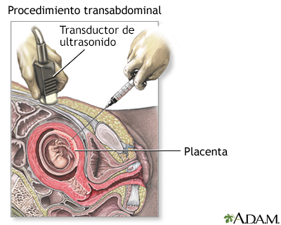 Procedimiento (segunda parte, transabdominal)