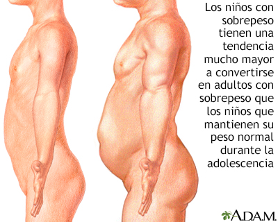 Obesidad infantil