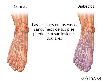 Circulación de la sangre diabética en el pie