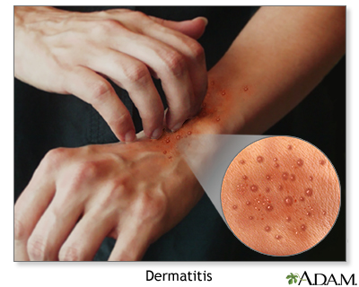 Dermatitis atópica