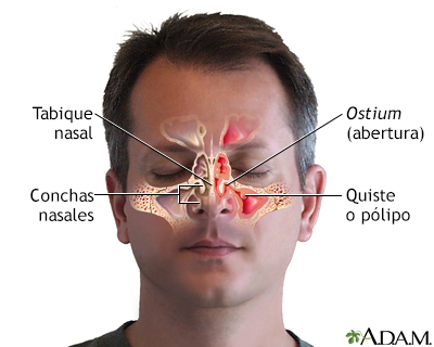 Sinusitis crónica