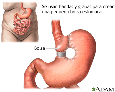 Gastroplastia vertical con banda