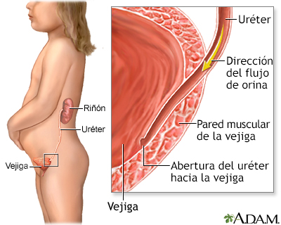 Reflujo vesicoureteral