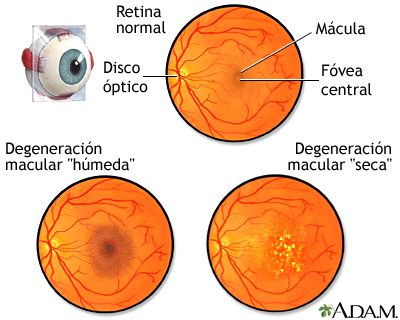 Degeneración macular