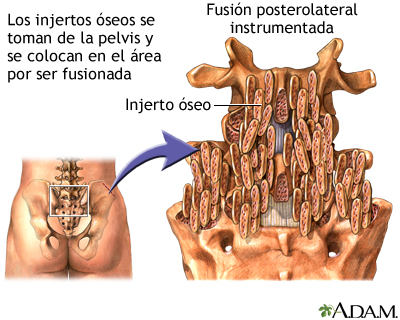 Procedimiento - Fusión posterolateral instrumentada