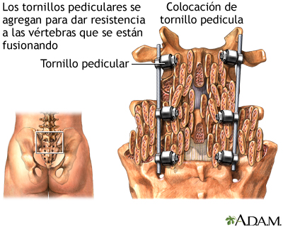 Tornillos pediculares