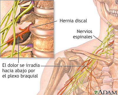 Dolor cervical