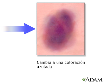 Cicatrización, parte 1