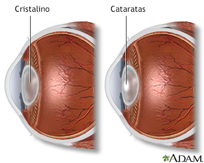 Catarata