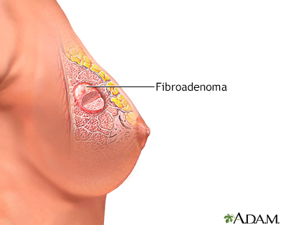 Fibroadenoma