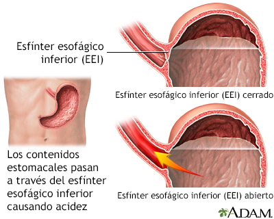 Enfermedad por reflujo gastroesofágico