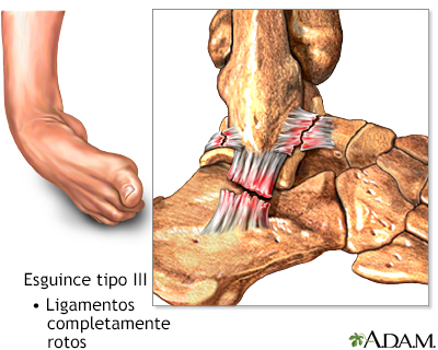 Esguince de tobillo tipo III