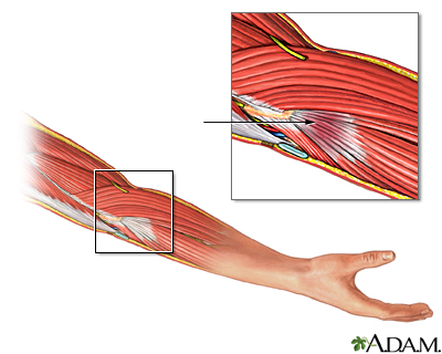 Tendinitis