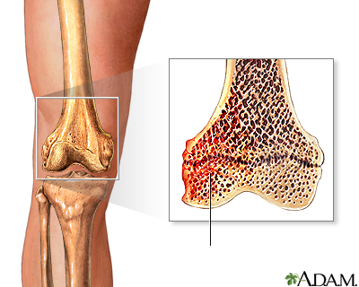 Hematoma óseo