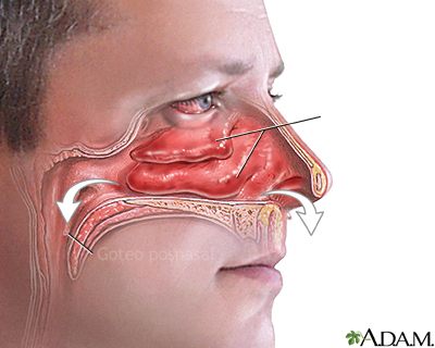 Goteo y congestión nasal