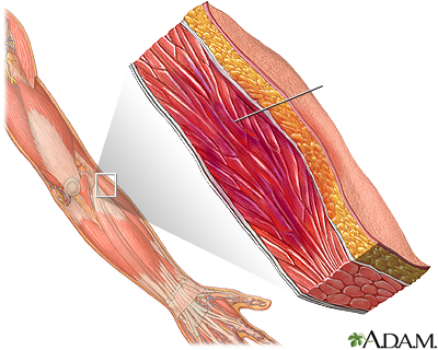 Hematoma muscular