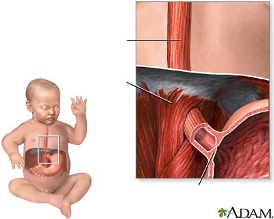 Regurgitación en los bebés