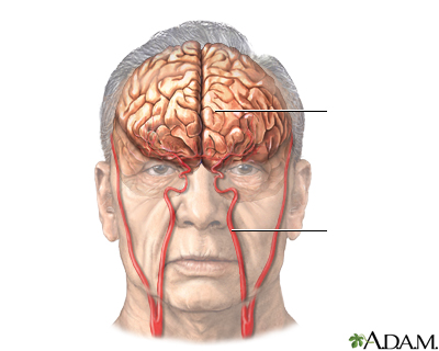 Accidente cerebrovascular - Serie