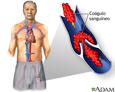 Accidente cerebrovascular - Parte 3