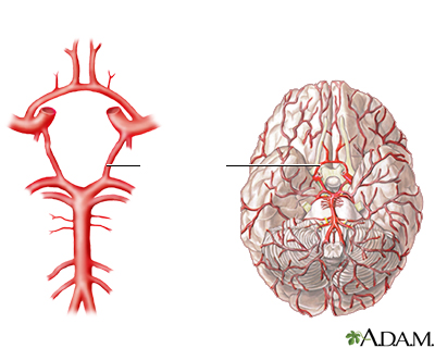 Accidente cerebrovascular - Parte 2