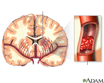 Accidente cerebrovascular - Parte 4