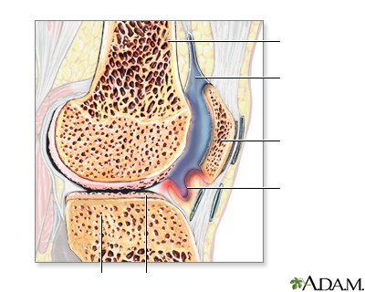 Artritis reumatoidea