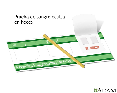 Prueba de sangre oculta en heces