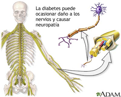 La diabetes y el daño a los nervios