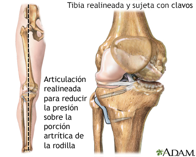 Rodilla después de una osteotomía tibial