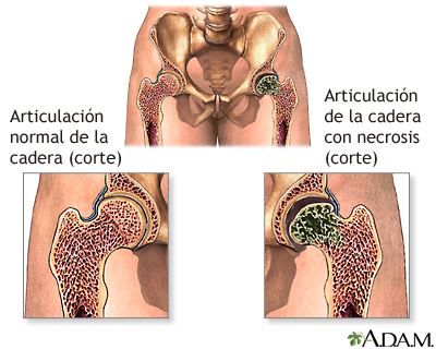 Necrosis aséptica