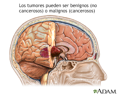 Tumor cerebral