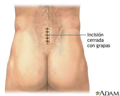 Microdiscectomía - Cuidados postoperatorios