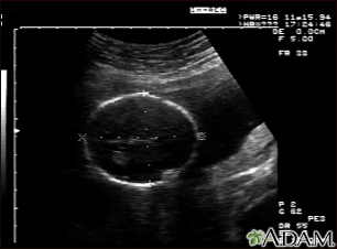 Ultrasonido de un feto normal - medidas de la cabeza