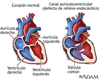 Canal auriculoventricular (defecto de relieve endocárdico)