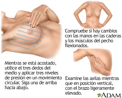 Autoexamen de seno