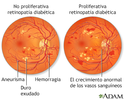 Retinopatía diabética