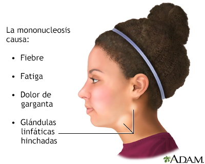 Mononucleosis infecciosa