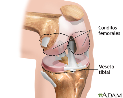 Serie sobre artroplastia de rodilla