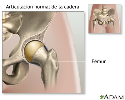 Serie sobre artroplastia de cadera