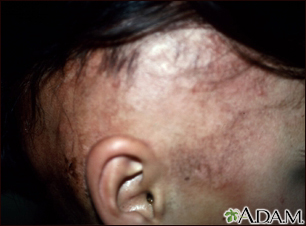 Alopecia bajo tratamiento