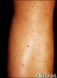 Foliculitis en la pierna