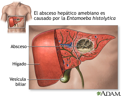 Absceso hepático amebiano