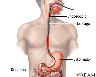 Esofagogastroduodenoscopia (EGD)