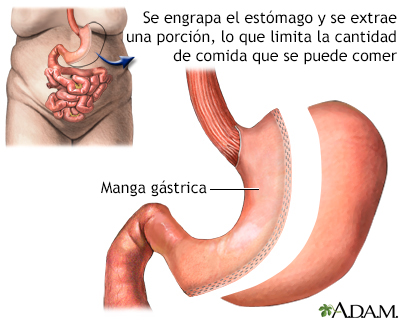 Procedimiento de manga gástrica