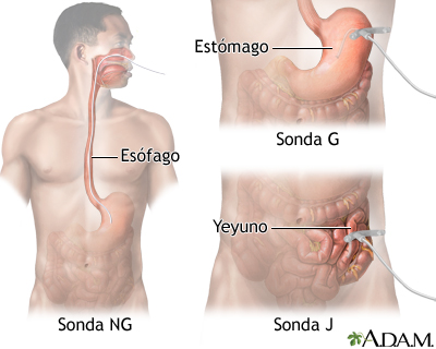 Sonda de alimentación